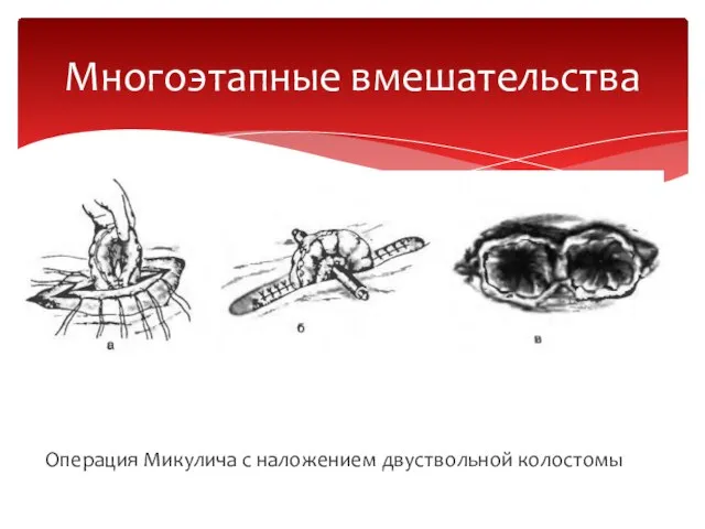 Операция Микулича с наложением двуствольной колостомы Многоэтапные вмешательства