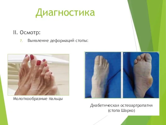 Диагностика II. Осмотр: Выявление деформаций стопы: Молоткообразные пальцы Диабетическая остеоартропатия (стопа Шарко)