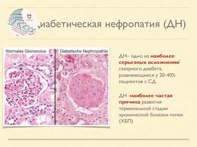 Диабетическая нефропатия (ДН) ДН– одно из наиболее серьезных осложнений сахарного диабета, развивающиеся