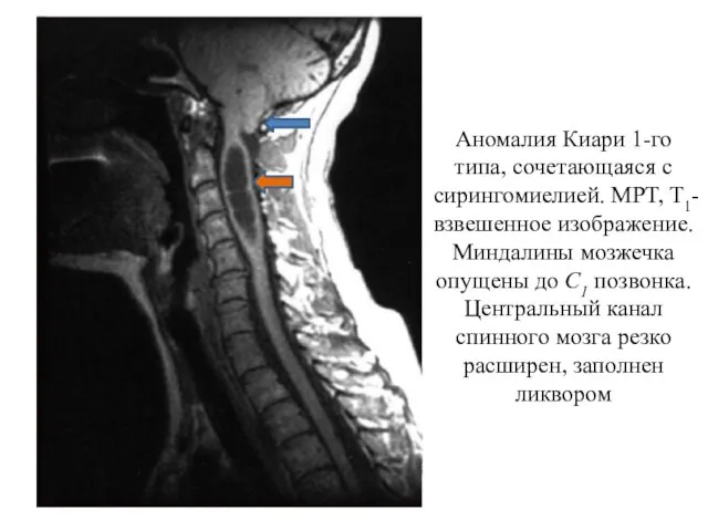 Аномалия Киари 1-го типа, сочетающаяся с сирингомиелией. МРТ, Т1-взвешенное изображение. Миндалины мозжечка