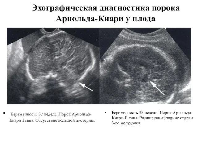 Эхографическая диагностика порока Арнольда-Киари у плода Беременность 37 недель. Порок Арнольда-Киари I