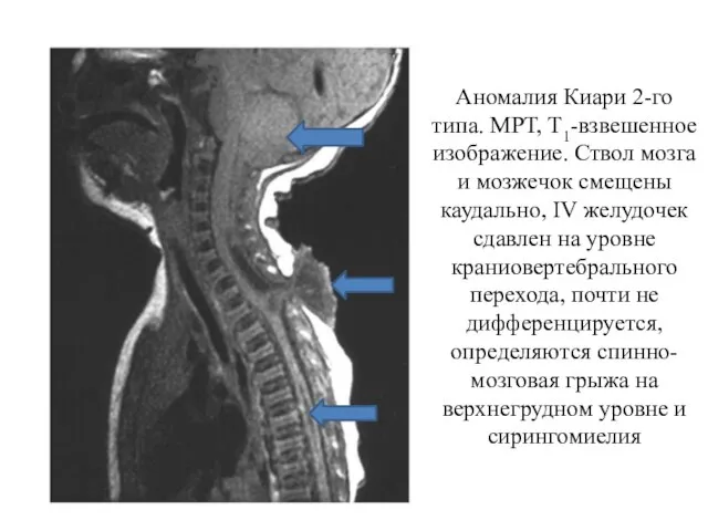 Аномалия Киари 2-го типа. МРТ, Т1-взвешенное изображение. Ствол мозга и мозжечок смещены