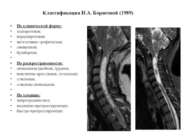 Классификация Н.А. Борисовой (1989) По клинической форме: заднероговая; переднероговая; вегетативно-трофическая; смешанная; бульбарная.