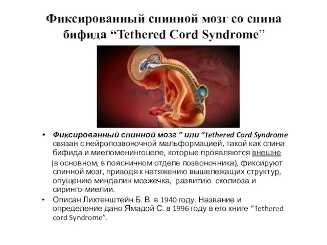 Фиксированный спинной мозг со спина бифида “Tethered Cord Syndrome” Фиксированный спинной мозг