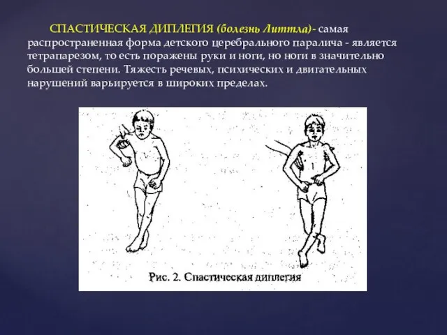 СПАСТИЧЕСКАЯ ДИПЛЕГИЯ (болезнь Литтла)- самая распространенная форма детского церебрального паралича - является