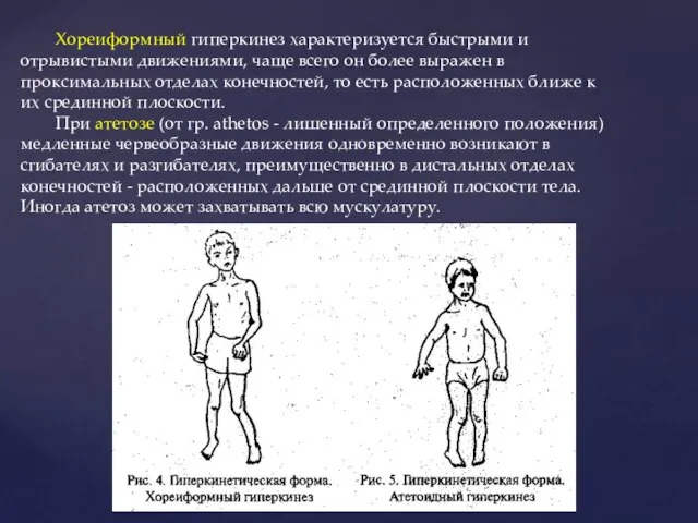 Хореиформный гиперкинез характеризуется быстрыми и отрывистыми движениями, чаще всего он более выражен