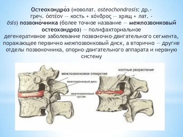 Остеохондро́з (новолат. osteochondrosis: др.-греч. ὀστέον — кость + χόνδρος — хрящ +