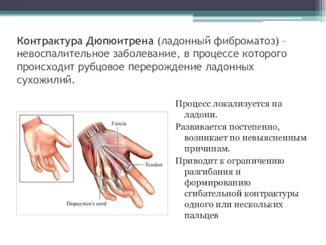 Контрактура Дюпюитрена (ладонный фиброматоз) – невоспалительное заболевание, в процессе которого происходит рубцовое