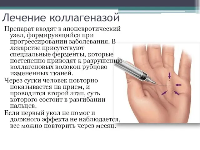 Лечение коллагеназой Препарат вводят в апоневротический узел, формирующийся при прогрессировании заболевания. В