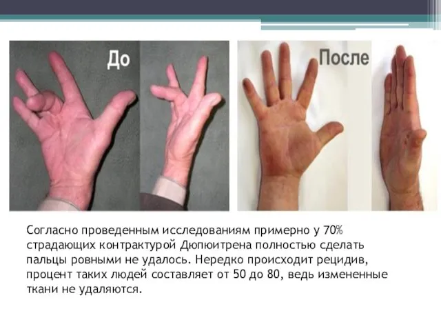 Согласно проведенным исследованиям примерно у 70% страдающих контрактурой Дюпюитрена полностью сделать пальцы