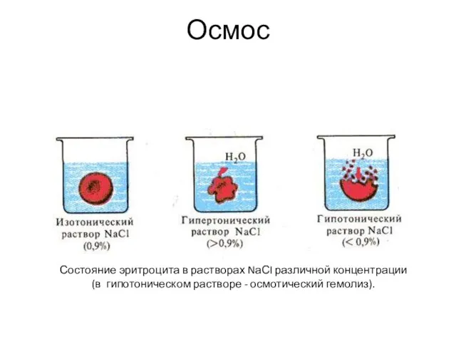 Осмос Состояние эритроцита в растворах NаСI различной концентрации (в гипотоническом растворе - осмотический гемолиз).