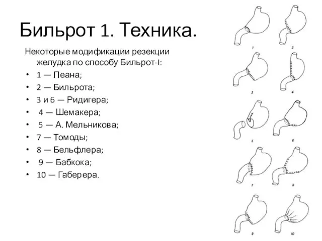 Бильрот 1. Техника. Некоторые модификации резекции желудка по способу Бильрот-I: 1 —