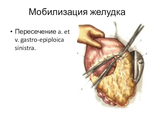 Мобилизация желудка Пересечение a. et v. gastro-epiploica sinistra.