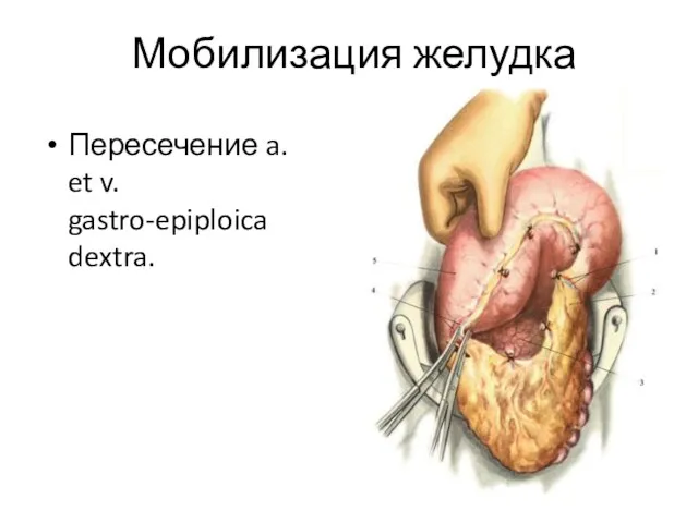 Мобилизация желудка Пересечение a. et v. gastro-epiploica dextra.