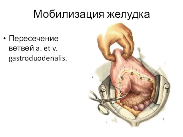 Мобилизация желудка Пересечение ветвей a. et v. gastroduodenalis.