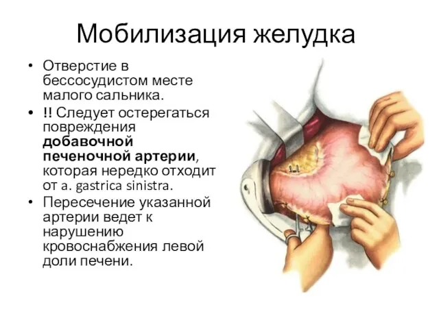 Мобилизация желудка Отверстие в бессосудистом месте малого сальника. !! Следует остерегаться повреждения