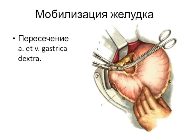 Мобилизация желудка Пересечение a. et v. gastrica dextra.