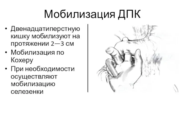 Мобилизация ДПК Двенадцатиперстную кишку мобилизуют на протяжении 2—3 см Мобилизация по Кохеру