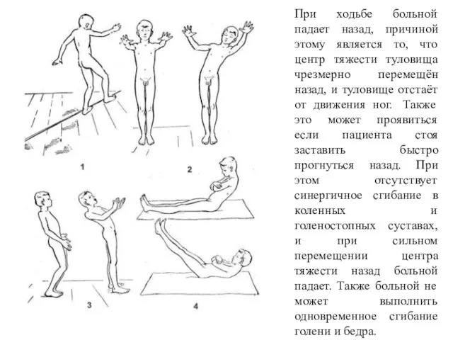 При ходьбе больной падает назад, причиной этому является то, что центр тяжести