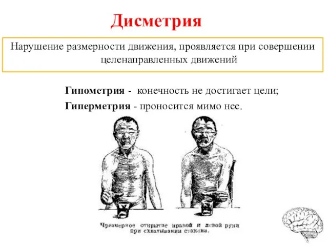 Дисметрия Нарушение размерности движения, проявляется при совершении целенаправленных движений Гипометрия - конечность