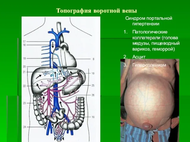 Топография воротной вены Синдром портальной гипертензии Патологические коллатерали (голова медузы, пищеводный варикоз, геморрой) Асцит Гиперспленизм