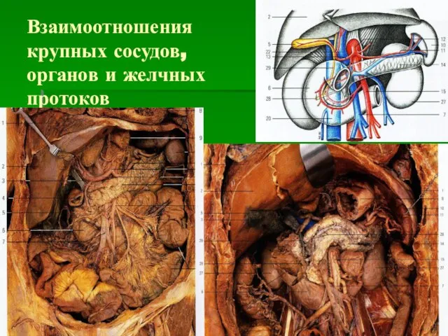 Взаимоотношения крупных сосудов, органов и желчных протоков