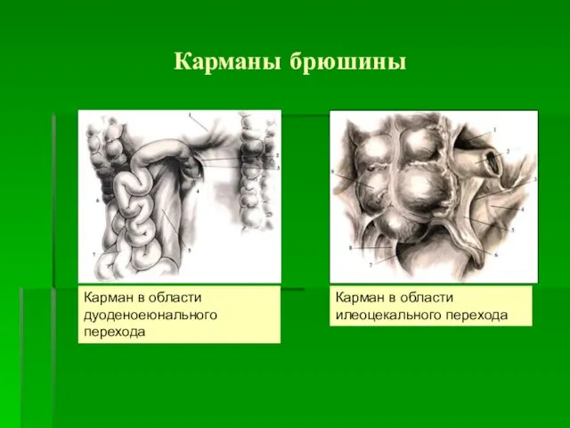 Карманы брюшины Карман в области дуоденоеюнального перехода Карман в области илеоцекального перехода