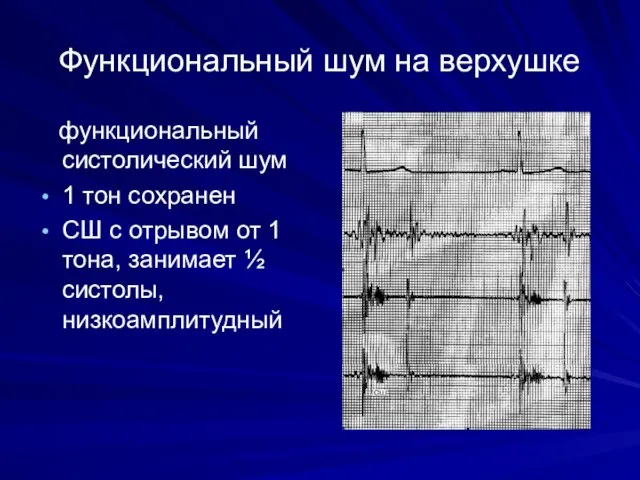 Функциональный шум на верхушке функциональный систолический шум 1 тон сохранен СШ с