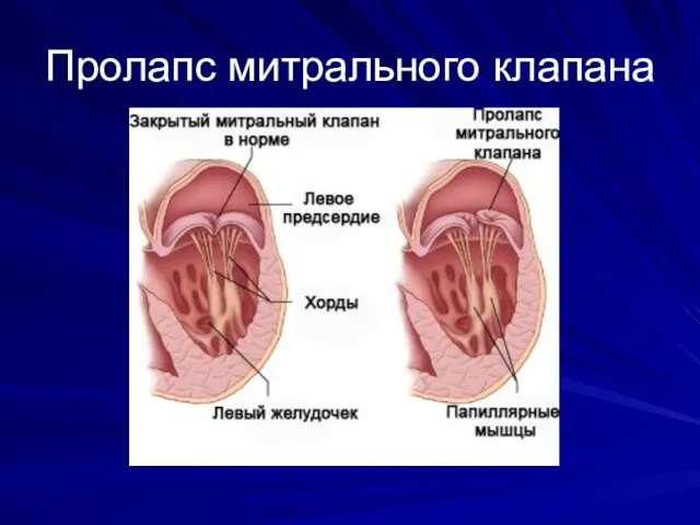 Пролапс митрального клапана