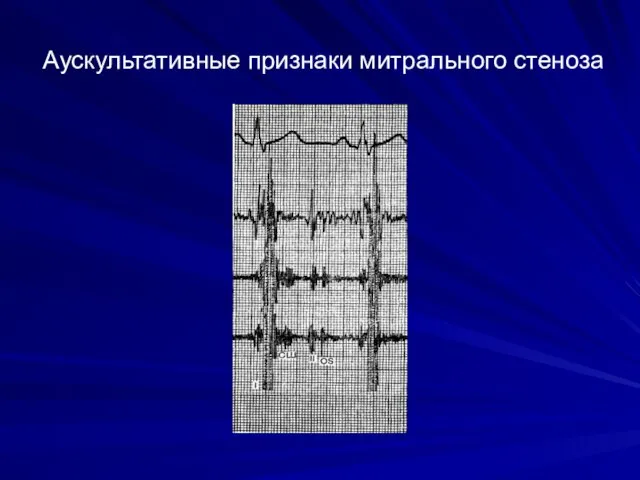 Аускультативные признаки митрального стеноза