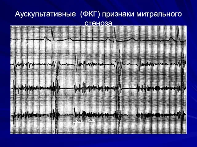 Аускультативные (ФКГ) признаки митрального стеноза