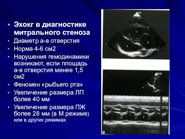 Эхокг в диагностике митрального стеноза Диаметр а-в отверстия Норма 4-6 см2 Нарушения