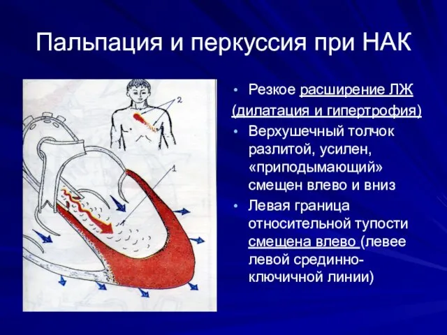 Пальпация и перкуссия при НАК Резкое расширение ЛЖ (дилатация и гипертрофия) Верхушечный