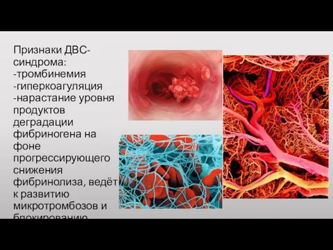 Признаки ДВС-синдрома: -тромбинемия -гиперкоагуляция -нарастание уровня продуктов деградации фибриногена на фоне прогрессирующего