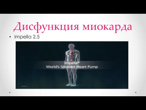 Дисфункция миокарда Impella 2.5