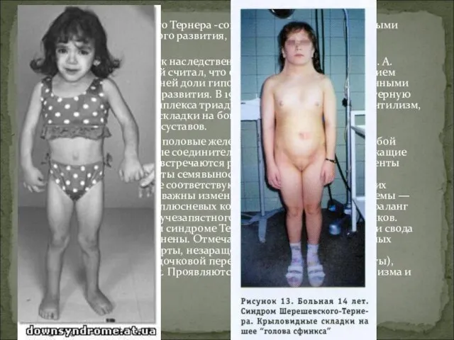 Синдром Шерешевского Тернера -сопровождающаяся характерными аномалиями физического развития, низкорослостью и половым инфантилизмом.