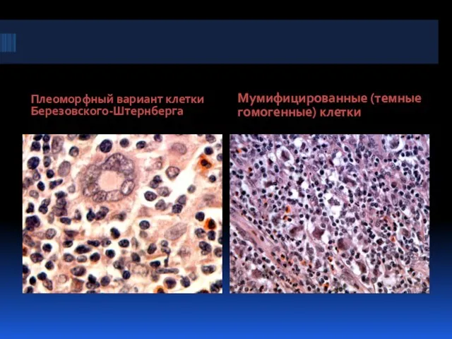 Плеоморфный вариант клетки Березовского-Штернберга Мумифицированные (темные гомогенные) клетки