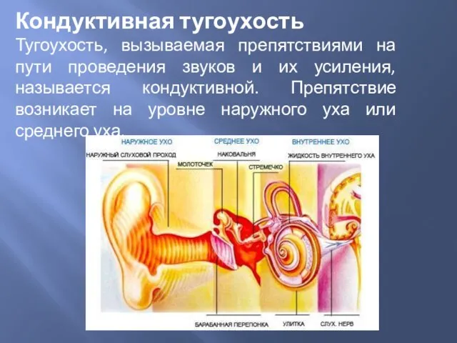 Кондуктивная тугоухость Тугоухость, вызываемая препятствиями на пути проведения звуков и их усиления,