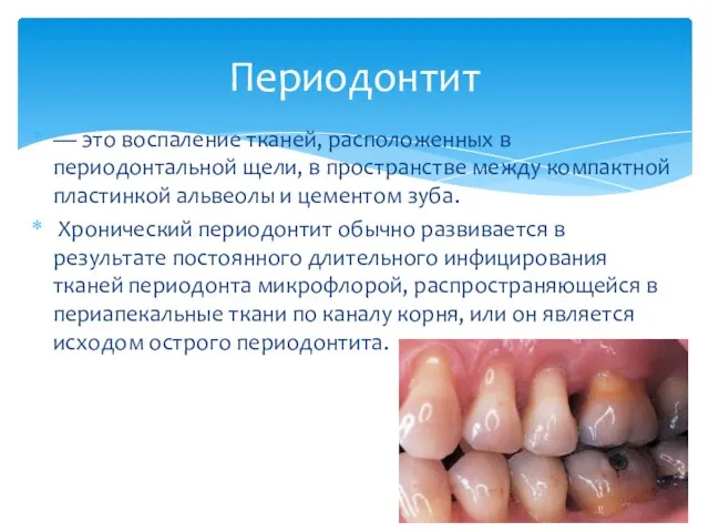 — это воспаление тканей, расположенных в периодонтальной щели, в пространстве между компактной