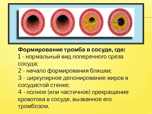 Формирование тромба в сосуде, где: 1 - нормальный вид поперечного среза сосуда;