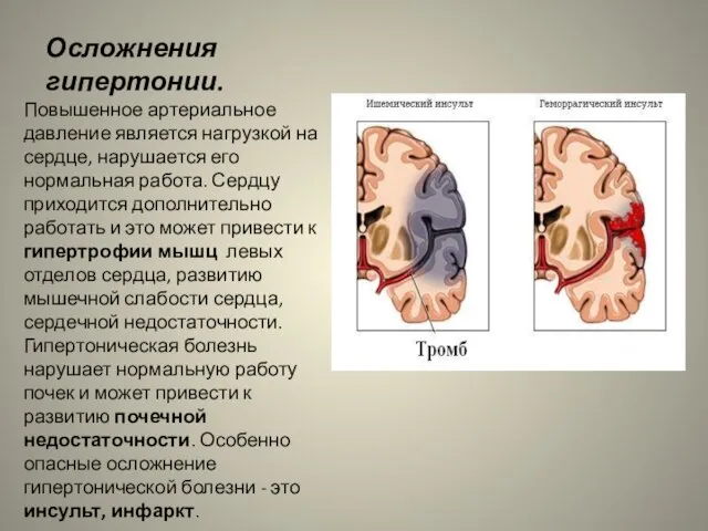 Осложнения гипертонии. Повышенное артериальное давление является нагрузкой на сердце, нарушается его нормальная