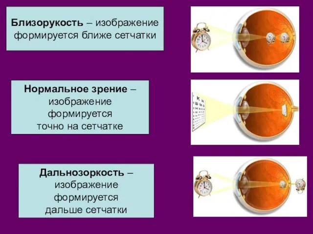 Близорукость – изображение формируется ближе сетчатки Нормальное зрение – изображение формируется точно