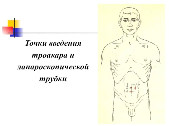 Точки введения троакара и лапароскопической трубки