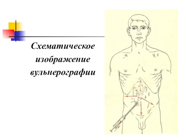 Схематическое изображение вульнерографии