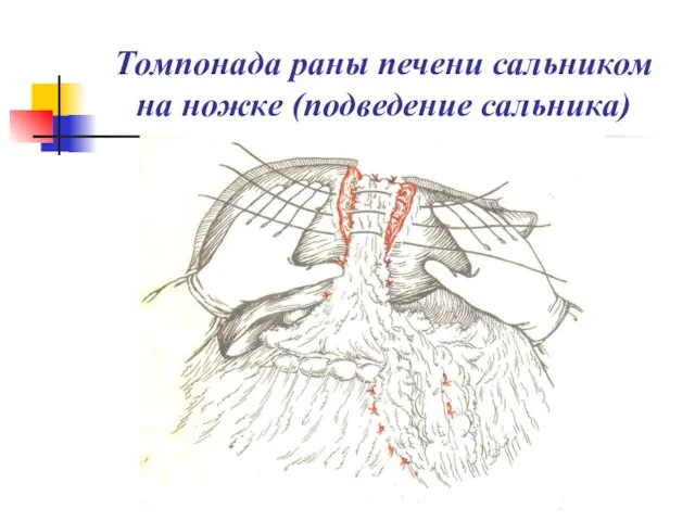 Томпонада раны печени сальником на ножке (подведение сальника)