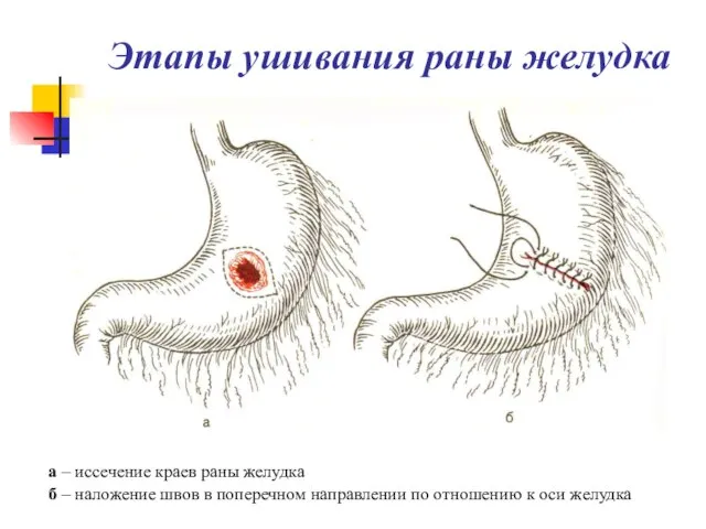 Этапы ушивания раны желудка а – иссечение краев раны желудка б –