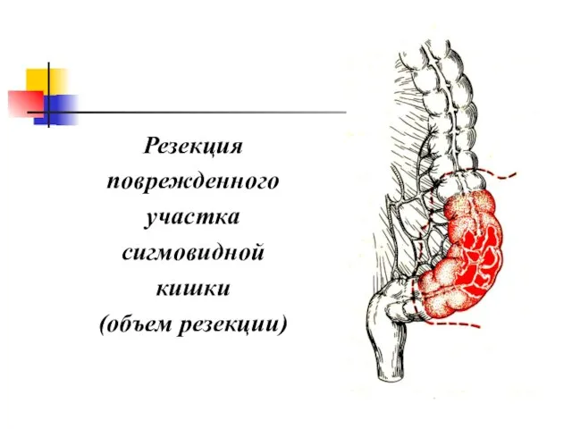 Резекция поврежденного участка сигмовидной кишки (объем резекции)