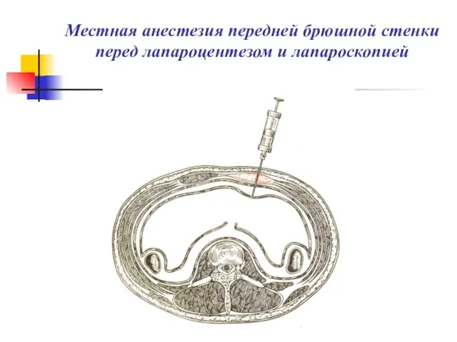 Местная анестезия передней брюшной стенки перед лапароцентезом и лапароскопией