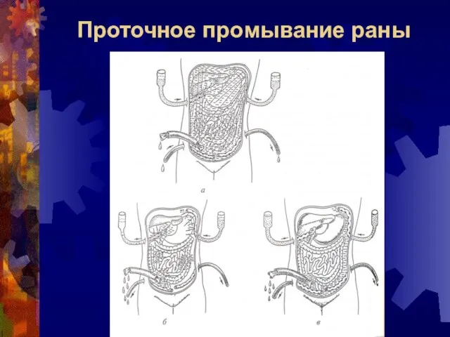 Проточное промывание раны