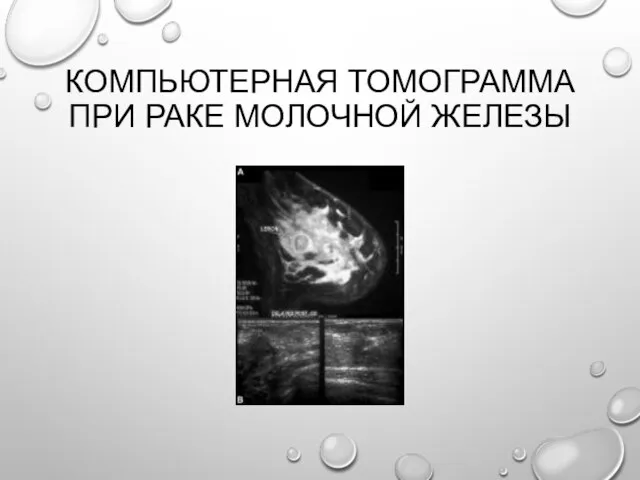 Компьютерная томограмма при раке молочной железы